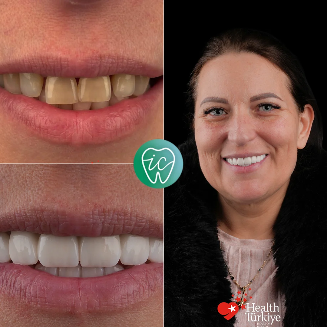 Treatment before and after